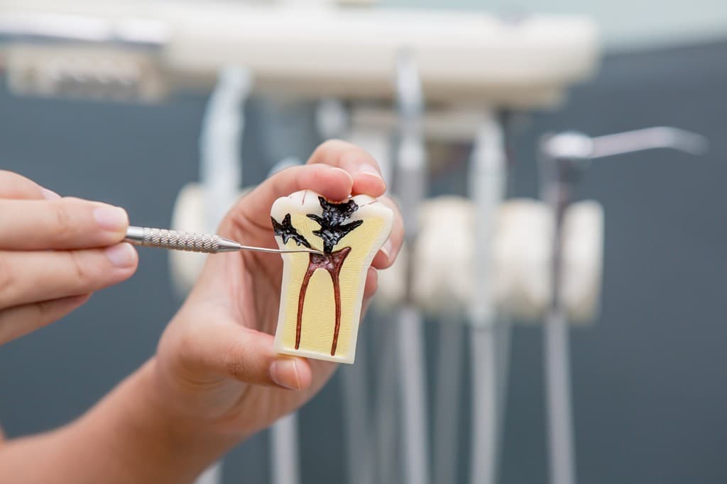 Endodoncia precio en Lugo