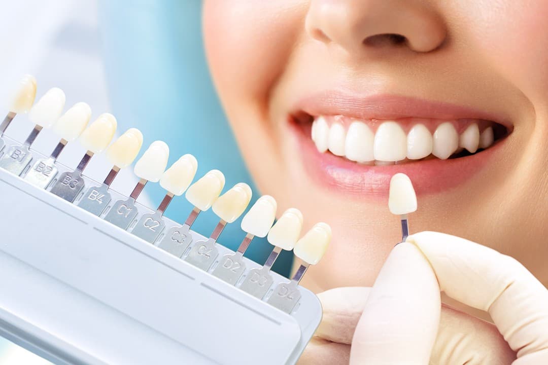 Carillas esteticas dentales en Lugo