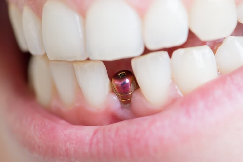Implantologo dental en Lugo