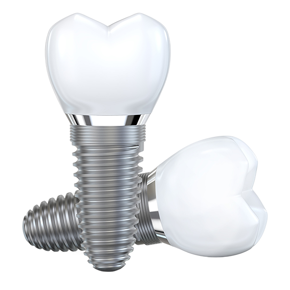 Implantes dentales en Lugo