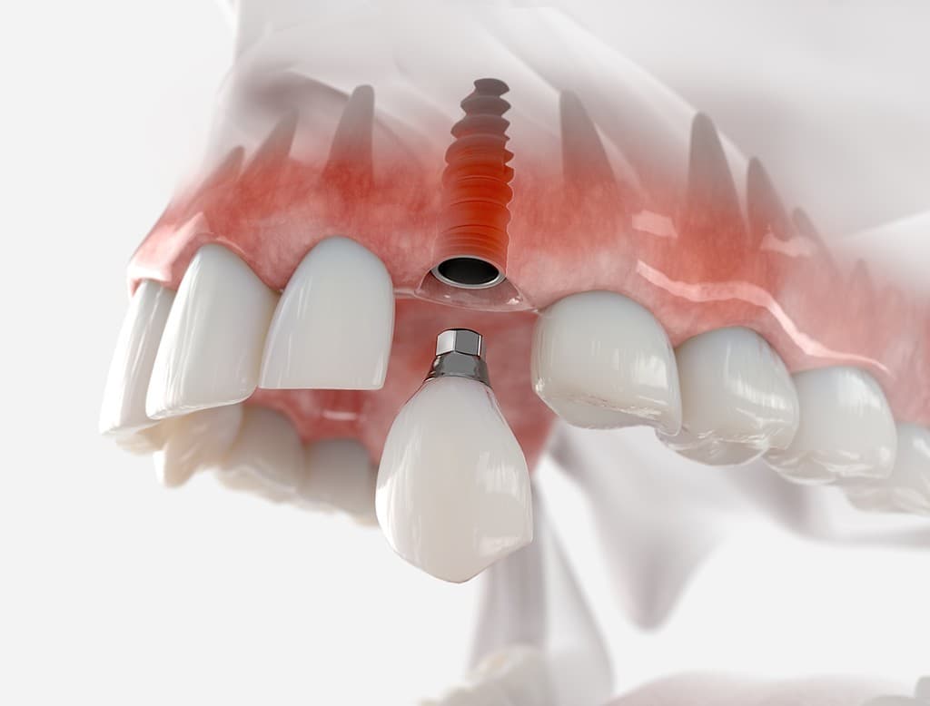 Precio implante dental en Lugo